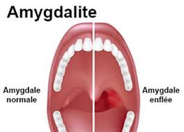 Les adultes qui se sont fait opérer en gardent. Amygdalectomie Definition Technique Docteurclic Com