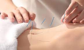 Did you complete 1,800 hours of acupuncture training from an accredited acupuncture school? Acupuncture Near Bedford Texas Vwellnessclinic Com