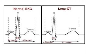 Image result for QT Interval
