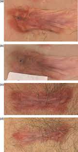 Treatment Of Keloid Scars With Intralesional Triamcinolone And 5 Fluorouracil Injections A Randomized Controlled Trial Journal Of Plastic Reconstructive Aesthetic Surgery