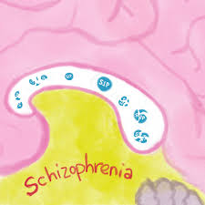 Schizophrenia is a serious mental illness that affects how a person thinks, feels, and behaves. Sphingolipid S1p Potential New Target For Schizophrenia Treatment It Ain T Magic