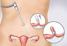 Birth Control Options Pictures Types Side Effects Costs Effectiveness