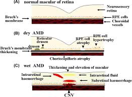 Age Related Macular Degeneration An Overview Sciencedirect Topics