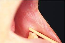Bedenklich Veranderungen Der Mundschleimhaut Zwp Online Das Nachrichtenportal Fur Die Dentalbranche
