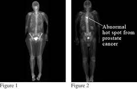 These include your blood pressure, heart rate and metab. Bone Scan Of The Spread Of Prostate Cancer Northshore