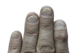 This fingernail condition includes black lines on the nails, nail discoloration, and/or excessive pigmentation. Nail Psoriasis Causes Symptoms Diagnosis Treatment