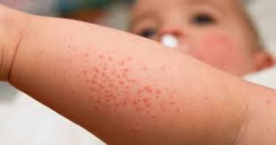 Allergiya Na Antibiotiki Prichiny Razvitiya Harakternye Priznaki Diagnostika I Principy Lecheniya