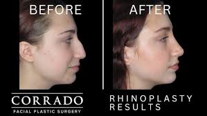 Rhinoplasty Before and After Results: Rotating Video