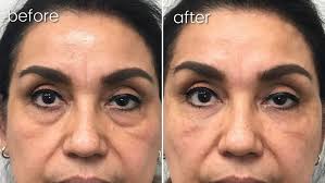 Facial Fillers Bakersfield, CA