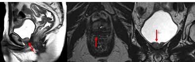 Or they might have spread to other parts of your body. Cureus Mri Guided Dose Escalated Salvage Radiotherapy For Bulky Bladder Neck Recurrence Of Prostate Cancer