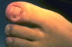 Image result for Paronychia feet