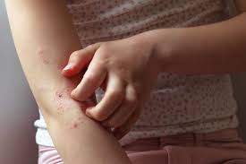 Image result for Neurodermatitis