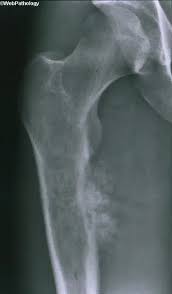 Image result for Chondrosarcoma