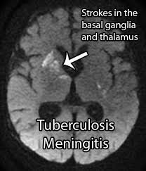 Virtualmedstudent Com Tuberculosis Meningitis Meningitis Radiology Imaging Medical Knowledge