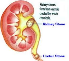 Kidney Stone Remedy Using Coke And Asparagus Kidney Stones Remedy Natural Treatments Kidney Health