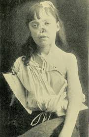 Syphilitic infection of the nervous system results in the most chronic, insidious meningeal inflammatory process known. Syphilis Shocking Photos Of Victims Before Penicillin Lj Charleston