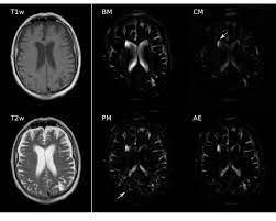 Brain Atrophy In Aging The Basic Model Bm Was Particularly Download Scientific Diagram