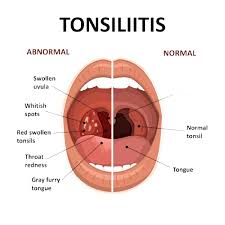Image result for Strep throat infection roof of mouth