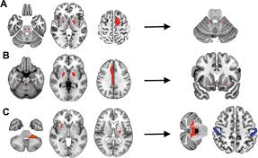 Image result for Neurologic Lesion Localization