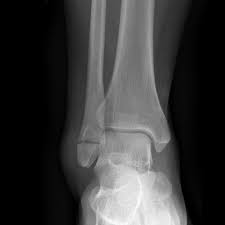 For some reason, no one seems to like lateral knees, especially students. Ankle Fracture Wikidoc