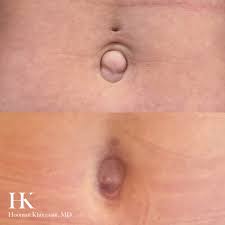 Belly Button Revision Cosmetic Surgeon Nyc