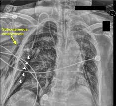Image result for Intrapleural Anesthesia