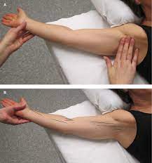Axillary Web Syndrome Following Breast Cancer Surgery Symptoms Compl Bctt