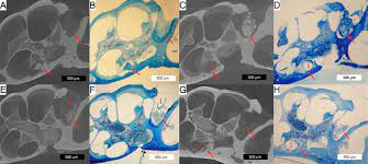 A cochlear implant works in the following way: A Mouse Model Of Cochlear Implantation With Chronic Electric Stimulation