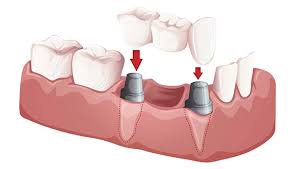 00 ($35.00/count) save more with subscribe & save. Temporary Solutions While Waiting For Your Dental Implant