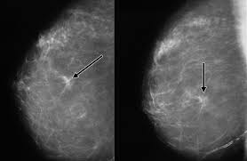 Macrocalcifications, which look like small white dots on a mammogram. 3 Facts About Breast Cancer Screening Every Woman Needs To Know El Camino Health