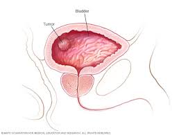 Bladder cancer is a cancer that starts in the bladder. Bladder Cancer Symptoms And Causes Mayo Clinic