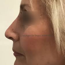 Photos avant-après chirurgie du visage et ORL