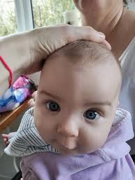 My son has mild/moderate metopic synostosis. He got checked when he was 2  months old and 8 months old. We were told it will be more of a cosmetic  surgery if we