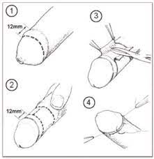 Kids Circumcision Serving Greater California Area Culver City Ca Gentle Circumcision