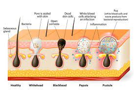 Acne Vulgaris Origins Symptoms And Current Treatments
