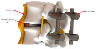 Hornet la frappe, leto, sadek, soprano & hornet la frappe, leto, sadek, soprano. Micromachines Free Full Text Design Of Customize Interbody Fusion Cages Of Ti64eli With Gradient Porosity By Selective Laser Melting Process Html