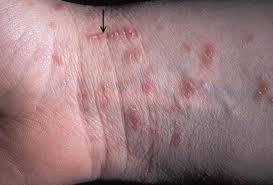 Image result for scabies human bites