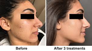 As to be expected, a microneedling treatment administered by your physician is a bit more. Microneedling Slate Medspa