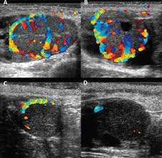 Wall filter, steer, angle correction. Color Doppler Flow Imaging For The Early Detection Of Nonpregnant Cattle At 20 Days After Timed Artificial Insemination Journal Of Dairy Science