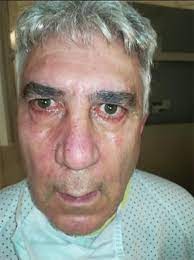 Maybe you would like to learn more about one of these? Facial Diplegia A Possible Atypical Variant Of Guillain Barre Syndrome As A Rare Neurological Complication Of Sars Cov 2 Sciencedirect