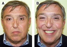 Iliac Crest Free Flap for Maxillary Reconstruction