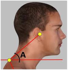 Cognitive Load and Dual-Task Performance in Individuals with and without  Forward Head Posture