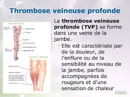 Bei einer thrombose bildet sich ein blutgerinnsel. Centre Abir Khelifi De Reeducation Et D Amincissement Thrombose Veineuse Profonde Facebook
