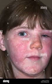 young girl with poison ivy rash