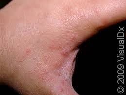 Image result for scabies human bites