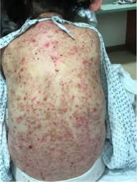 Image result for Neurotic Excoriation