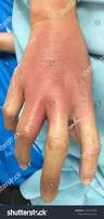 Image result for Hand Infection