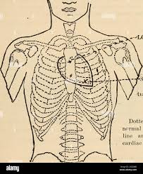 Image result for Venous Hum