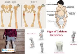Image result for Rickets