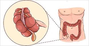 Learn about its function, parts, location in the body, and conditions that affect the appendix, as well as tests and treatments for appendix conditions. Appendicitis Causes Symptoms Treatment Prevention Tips